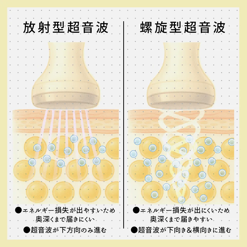 放射型超音波と螺旋型超音波の違い