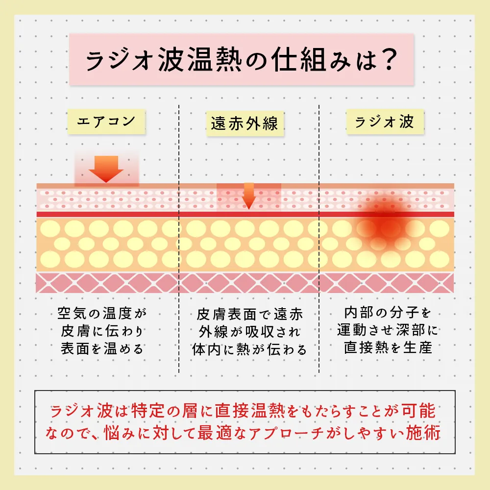 ラジオ波温熱の仕組みは？